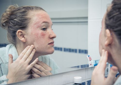 Learn These Home Remedies for a Dry Face Rash