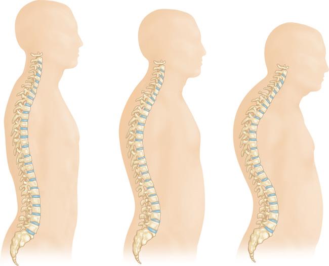 Bones and Calcium - Learn How They Relate