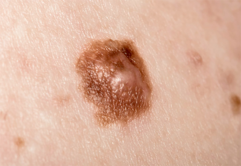 What Does a Healthy Mole Look Like?